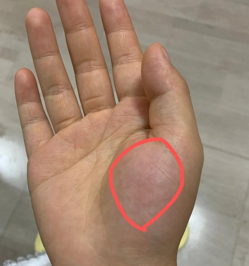 手掌发红是怎么回事？可能的原因和解决方法是什么？
